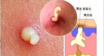 草莓鼻挤（草莓鼻挤出来白色的东西是什么）