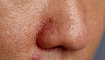 酒糟鼻一二三期（酒糟鼻分为几期）